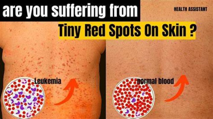 Are leukemia spots itchy?