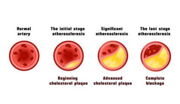 Can arterial plaque be reversed?