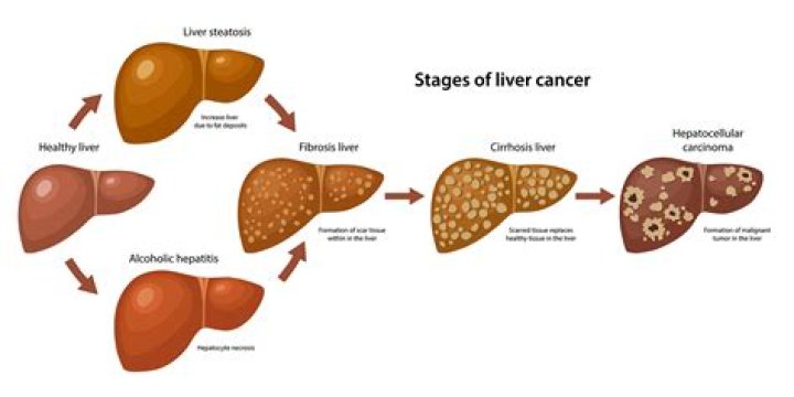 Can you survive hepatocellular carcinoma?