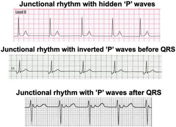 Does atropine work on junctional rhythms?
