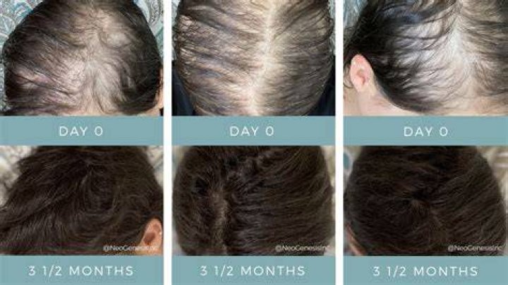 Does serum cause hair loss?