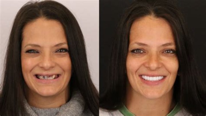 Does your face change with dentures?