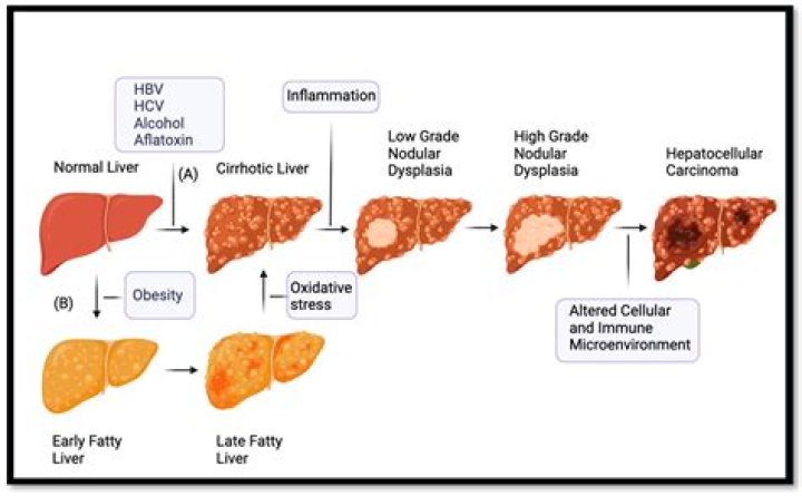 How does hepatocellular carcinoma spread?