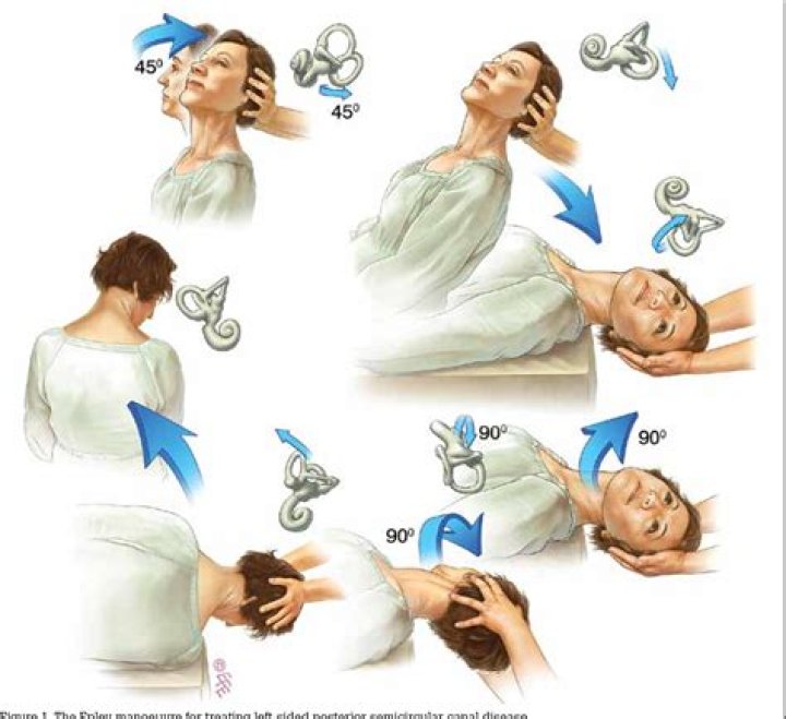 Should epley maneuver be repeated?