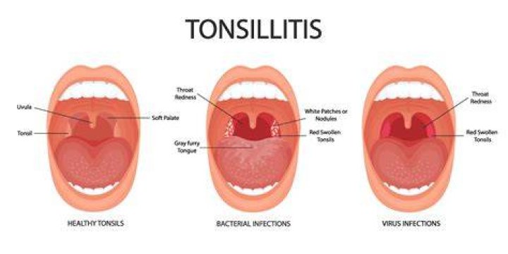 Were are tonsils located?