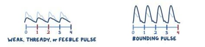 What does a thready pulse feel like?