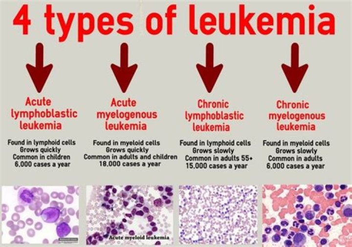 What type of cancer is acute lymphocytic leukemia?