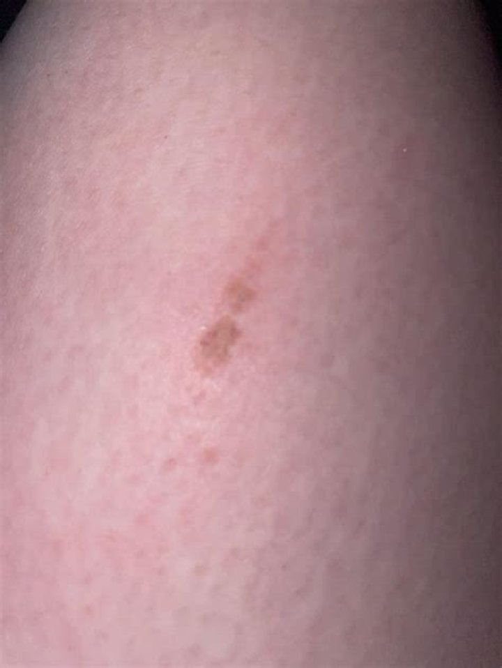Will friction burn scar?